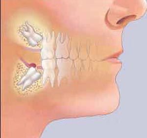 مشکلات در مورد دندان عقل
