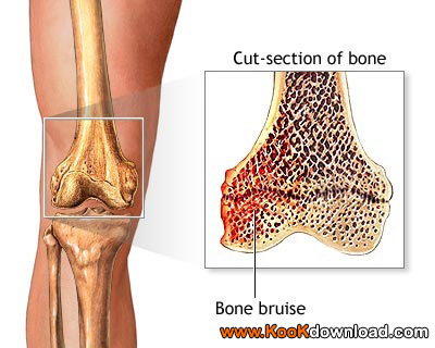 ۶ روش تقویت استخوان ها و جلوگیری از پوکی استخوان